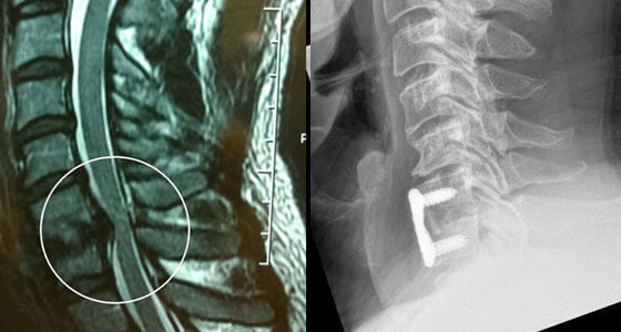 Cervical Surgery - Anterior Cervical Discectomy and Fusion